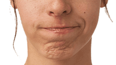 Peau dorange chin Lines Treatments In Floral Park, NY, at Jules Aesthetics