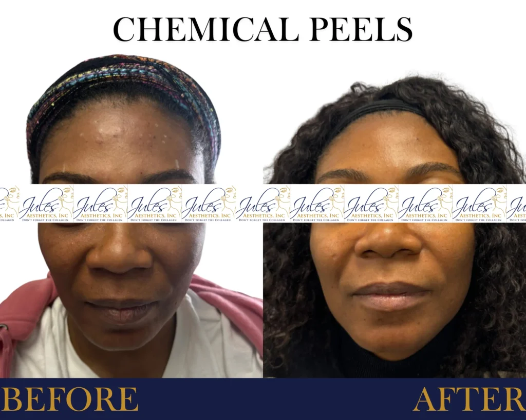Chemical Peels Before and After Result- Jules Aesthetics
