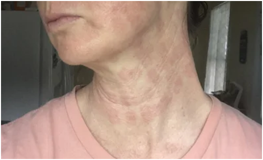 When RF Microneedling goes wrong and how we do it right