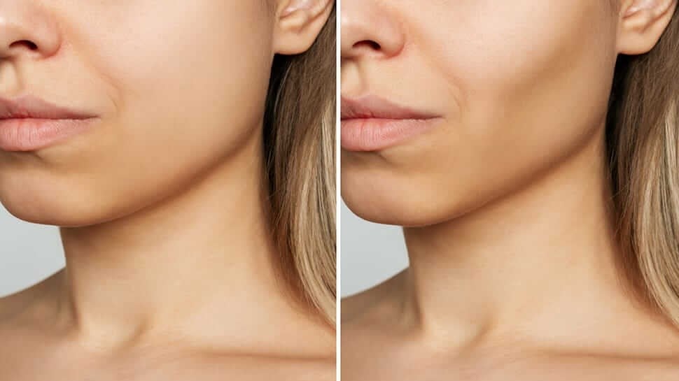 OZEMPIC FACE: HOW FILLERS CAN HELP RESTORE YOUR APPEARANCE