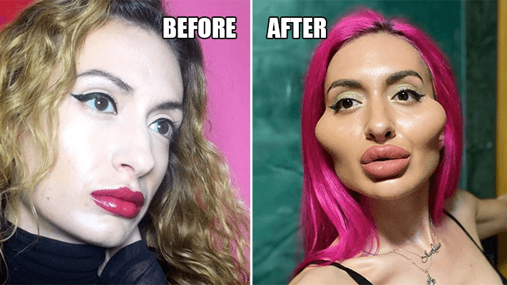 When Plump Becomes Puffed:Excessive Filler Injections