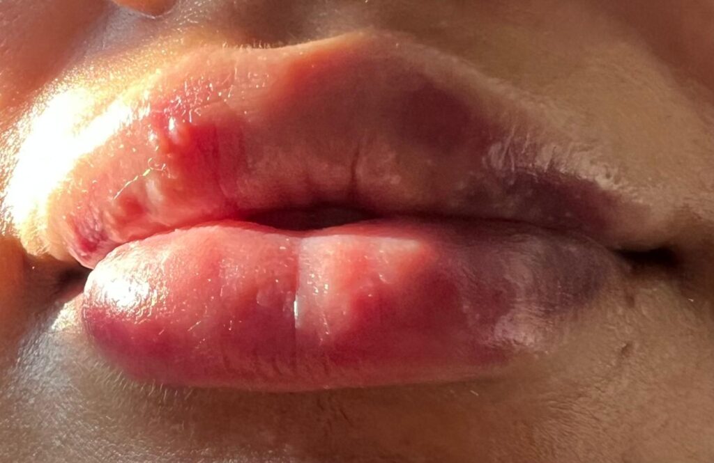 Expert lip filler correction at Jules Aesthetics in Floral Park, NY