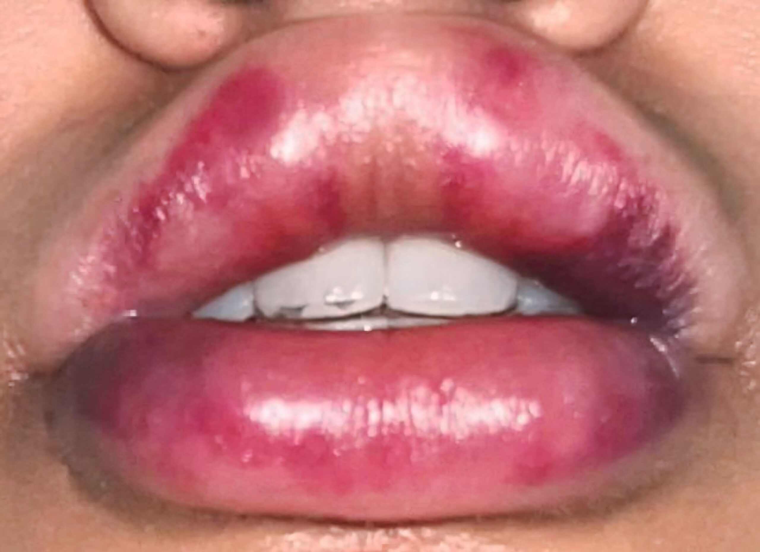 Can You Give Me Kylie’s Lips? : When Things Don’t Go as Planned
