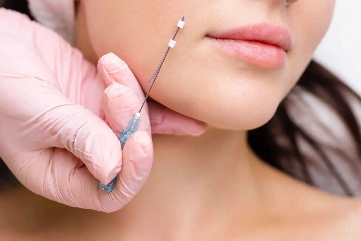 Top 5 Benefits of PDO Threads for a Youthful, Natural Look