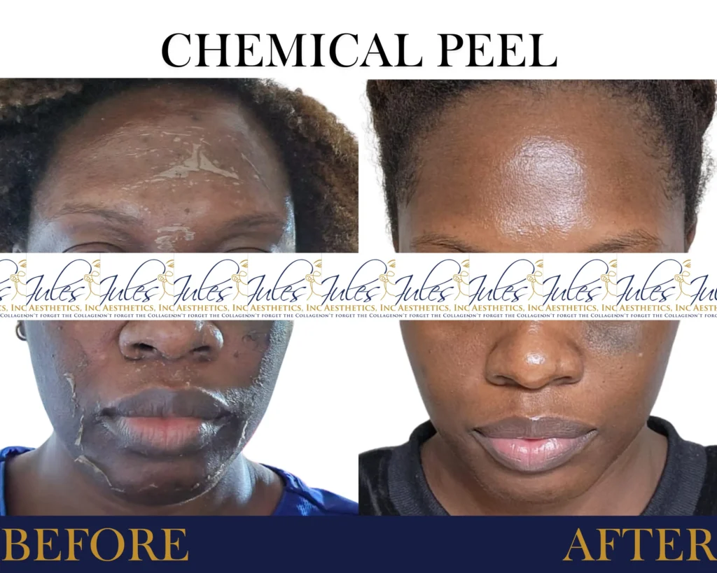 Chemical Peel Before and After Result- Jules Aesthetics