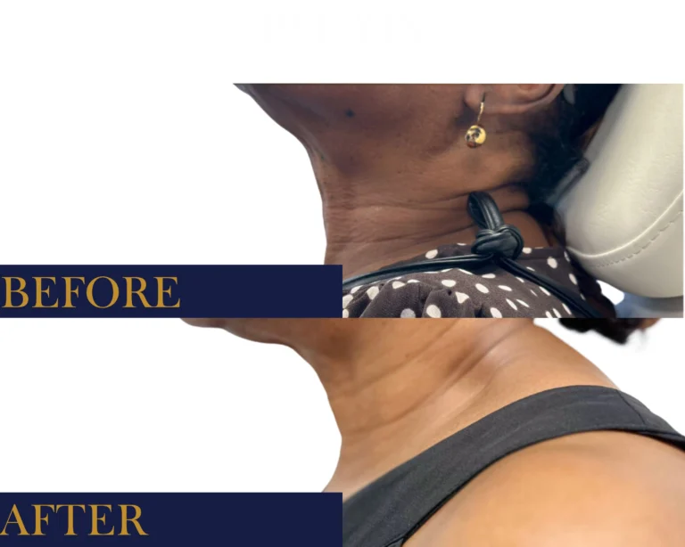 Neurotoxin Before and After Result- Jules Aesthetics
