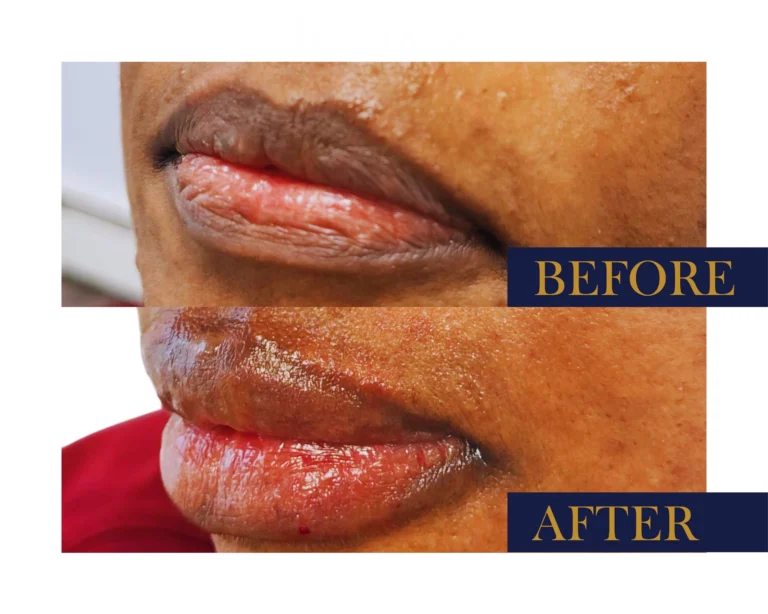 Hyaluronic Acid Fillers Before and After Result- Jules Aesthetics