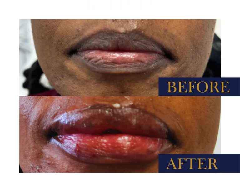Hyaluronic Acid Fillers Before and After Result- Jules Aesthetics