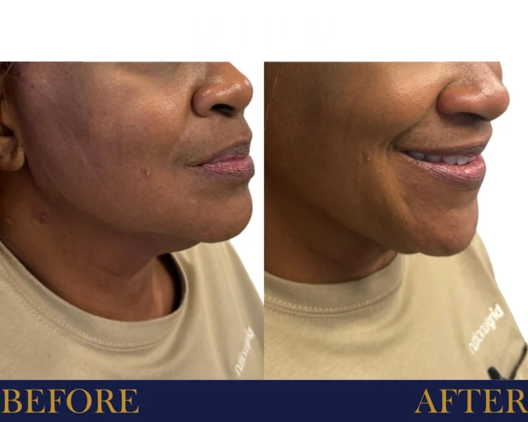 PDO threads jawline and neck lift Before and After Result- Jules Aesthetics