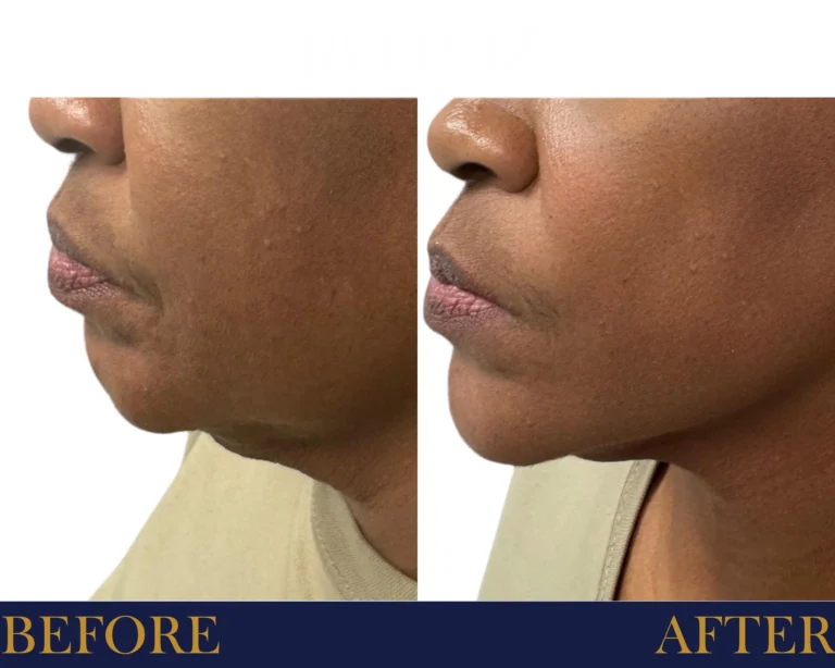 PDO threads jawline and neck lift Before and After Result- Jules Aesthetics