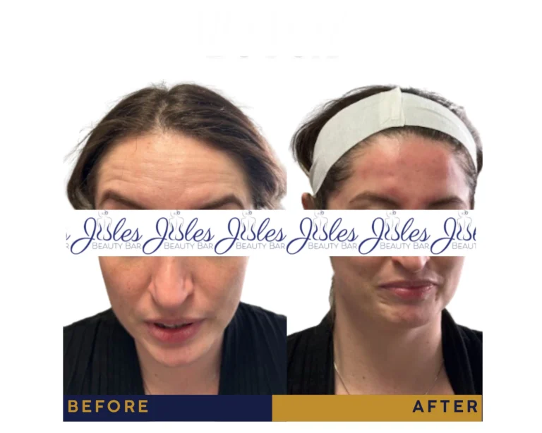 Neurotoxin Before and After Result- Jules Aesthetics