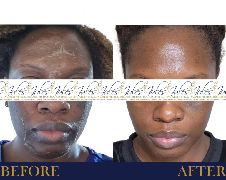 Chemical Peel Before and After Results- Jules Aesthetics