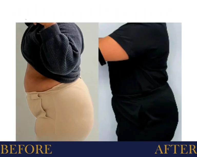 Weight Loss Program Before and After Results- Jules Aesthetics
