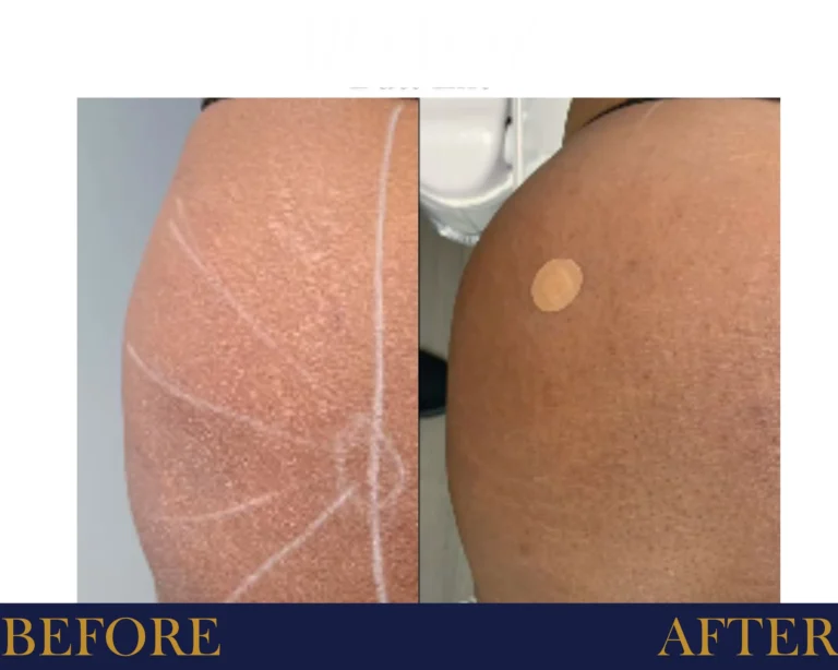 Biostimulator Fillers Before and After Result- Jules Aesthetics