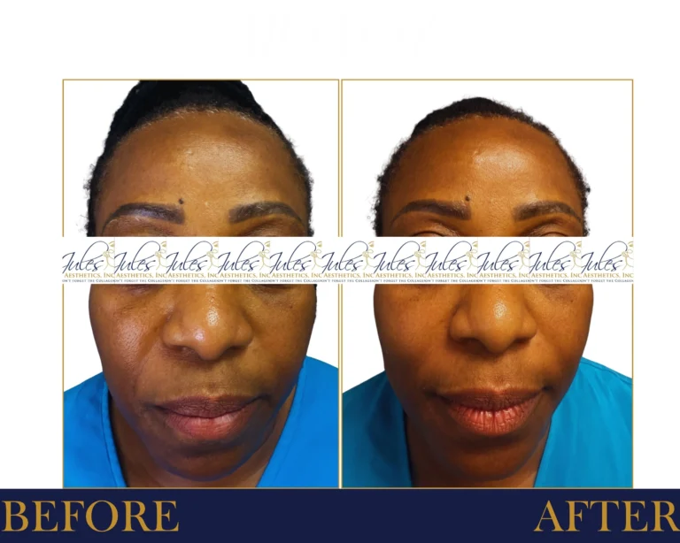 Neurotoxin Before and After Result- Jules Aesthetics