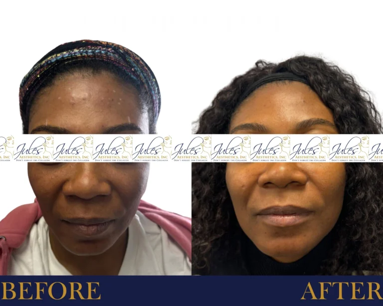 Chemical Peels Before and After Result- Jules Aesthetics