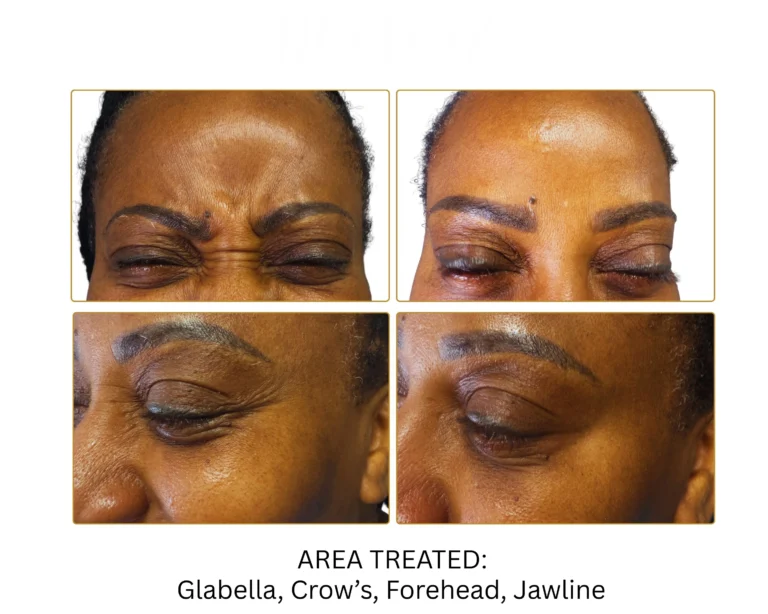 Neurotoxin Before and After Result- Jules Aesthetics