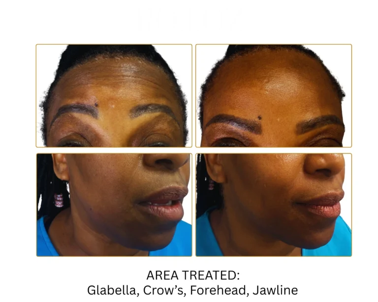 Neurotoxin Before and After Result- Jules Aesthetics
