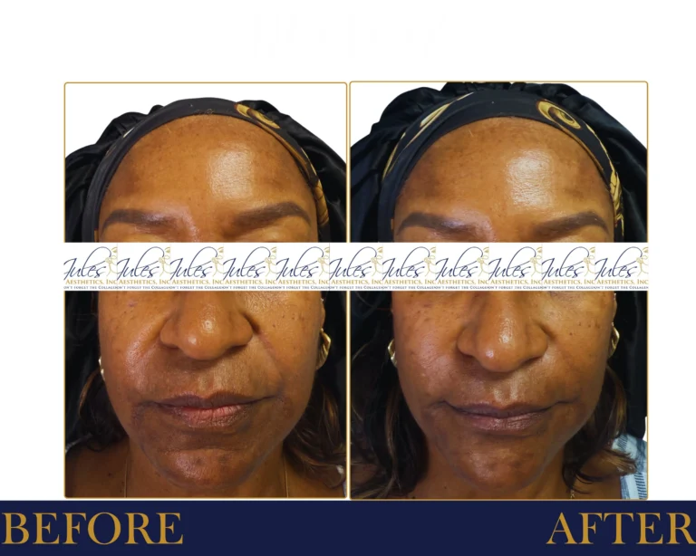 Biostimulator Fillers Before and After Result- Jules Aesthetics
