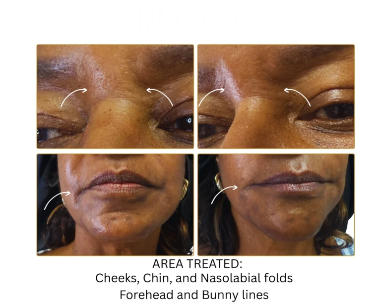 Biostimulator Fillers Before and After Result- Jules Aesthetics
