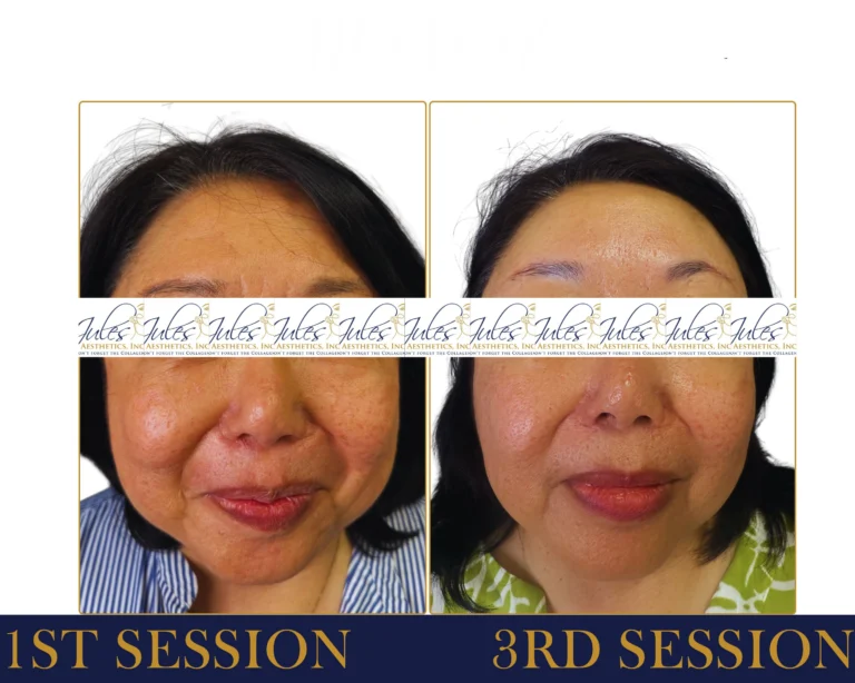 RF Microneedling Before and After Result- Jules Aesthetics