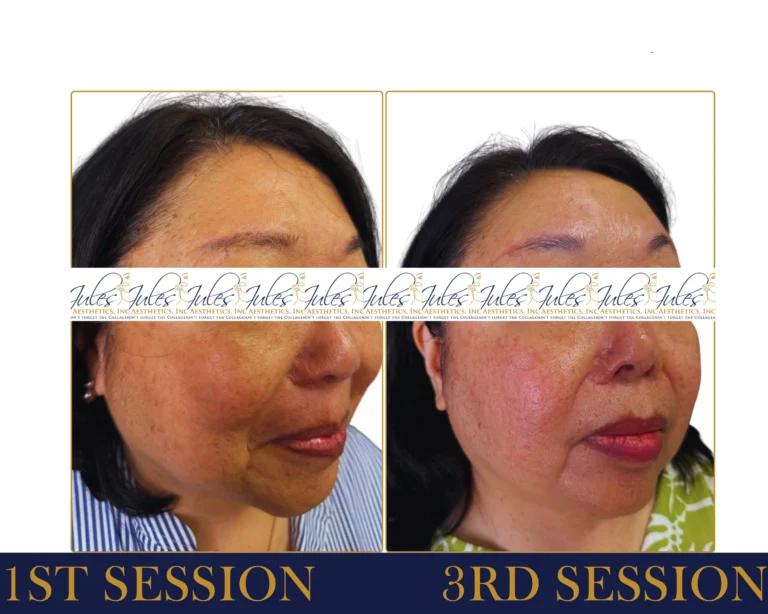 RF Microneedling Before and After Result- Jules Aesthetics