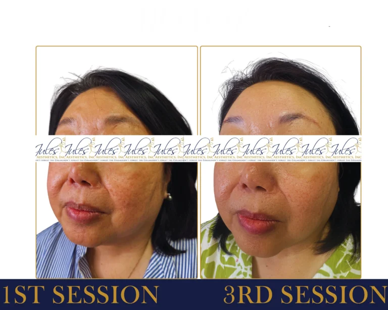 RF Microneedling Before and After Result- Jules Aesthetics