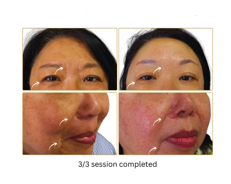 RF Microneedling Before and After Result- Jules Aesthetics