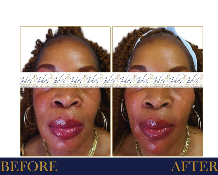 Biostimulator Fillers - Before and After Result- Jules Aesthetics