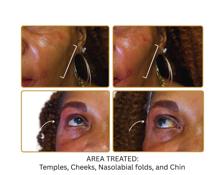 Biostimulator Fillers Before and After Result- Jules Aesthetics