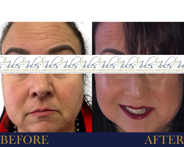 Biostimulator Fillers Before and After Result- Jules Aesthetics
