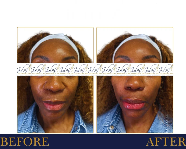 Hyaluronic Acid Fillers Before and After Result- Jules Aesthetics