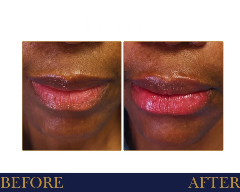 Hyaluronic Acid Fillers Before and After Result- Jules Aesthetics