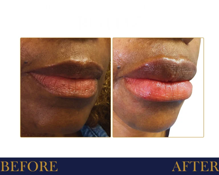 Hyaluronic Acid Fillers Before and After Result- Jules Aesthetics