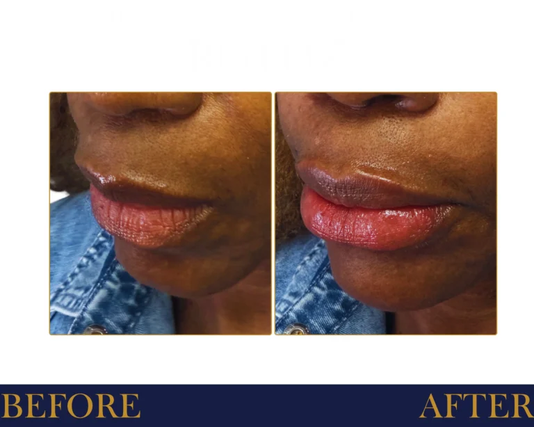 Hyaluronic Acid Fillers Before and After Result- Jules Aesthetics