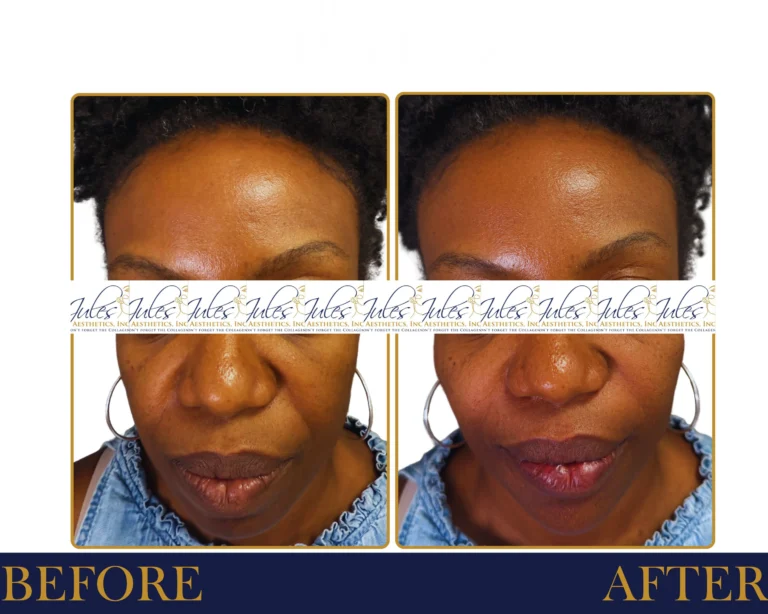Biostimulator Fillers - Before and After Result- Jules Aesthetics