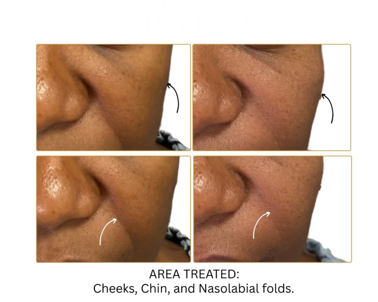 Biostimulator Fillers - Before and After Result- Jules Aesthetics