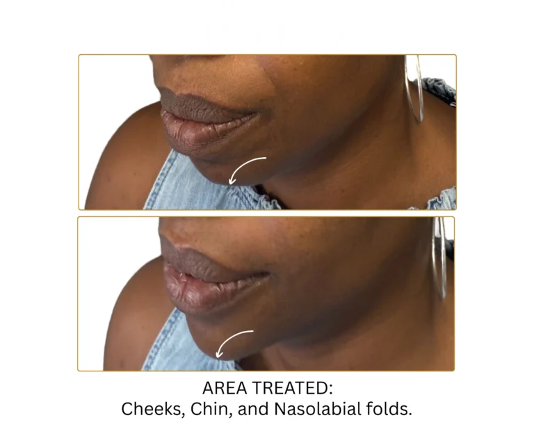 Biostimulator Fillers - Before and After Result- Jules Aesthetics