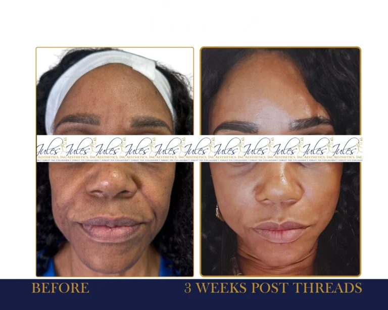 PDO Thread Lift Before and After Result- Jules Aesthetics