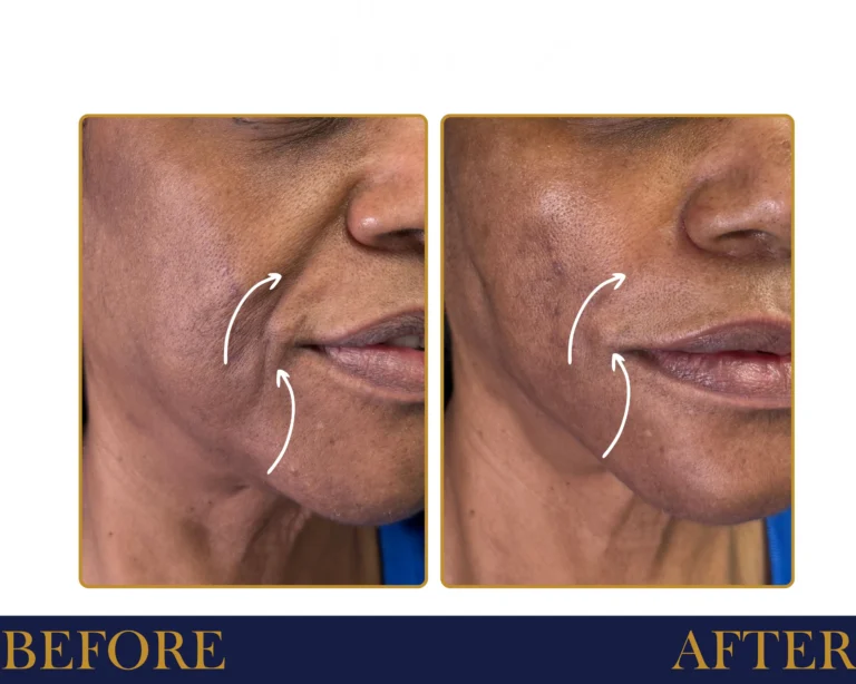 PDO Thread Lift Before and After Result- Jules Aesthetics