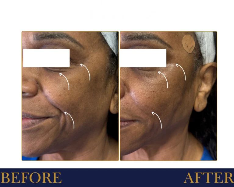 PDO Thread Lift Before and After Result- Jules Aesthetics