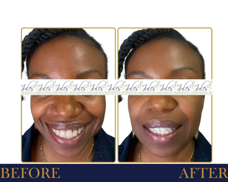 Neurotoxin Before and After Result- Jules Aesthetics
