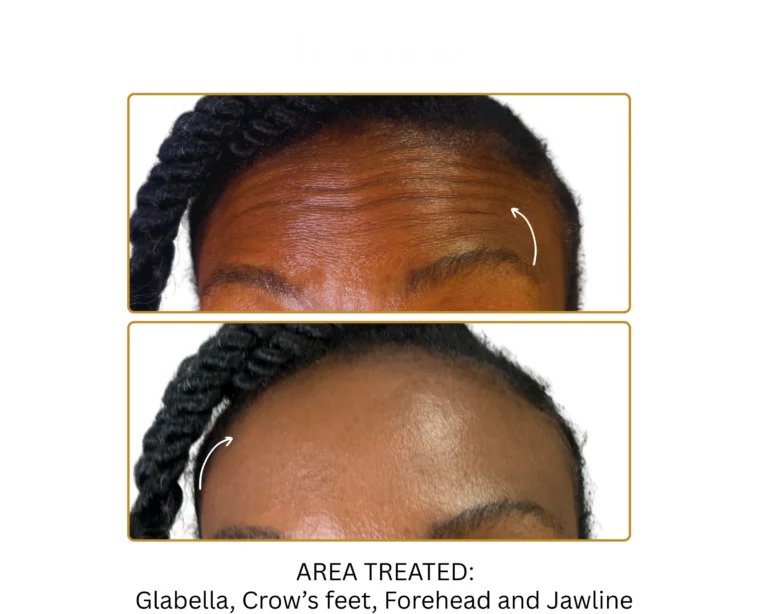 Neurotoxin Before and After Result- Jules Aesthetics