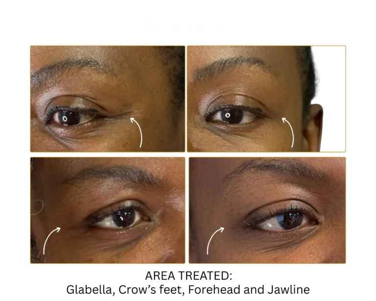 Neurotoxin Before and After Result- Jules Aesthetics