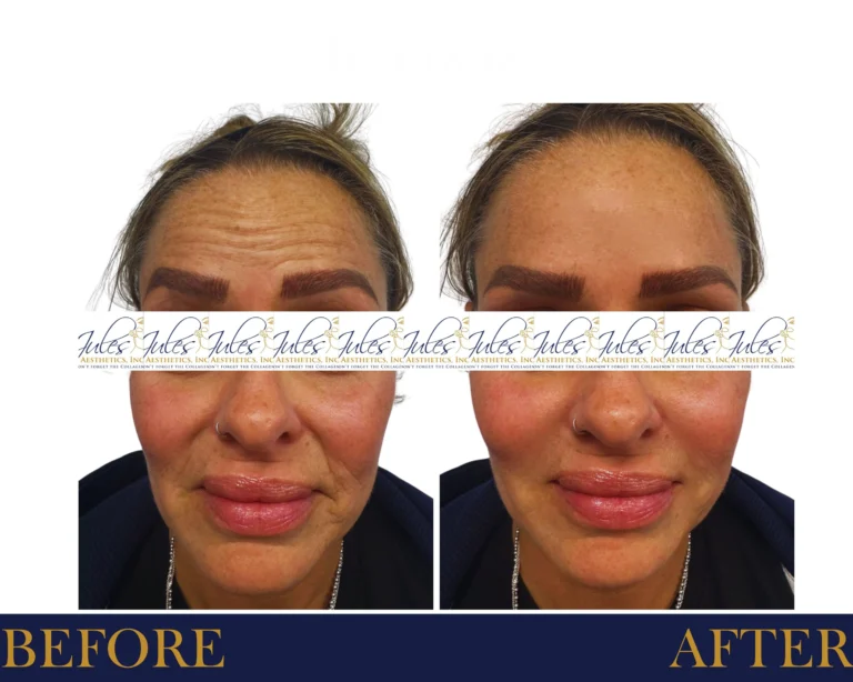 BOTOX, Dysport, JUVÉDERM, AND XEOMIN Before and After Result- Jules Aesthetics