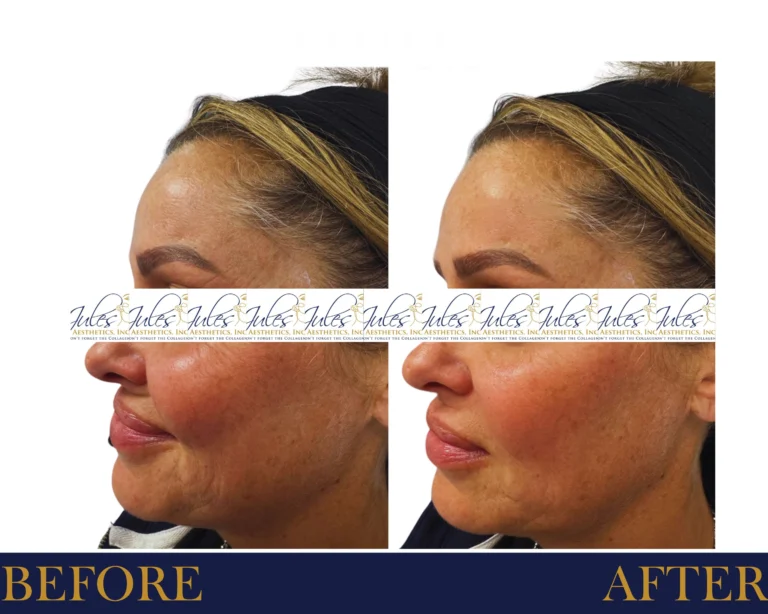 BOTOX, Dysport, JUVÉDERM, AND XEOMIN Before and After Result- Jules Aesthetics