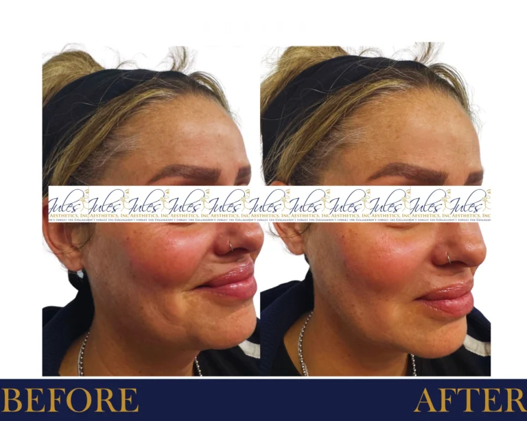 BOTOX, Dysport, JUVÉDERM, AND XEOMIN Before and After Result- Jules Aesthetics