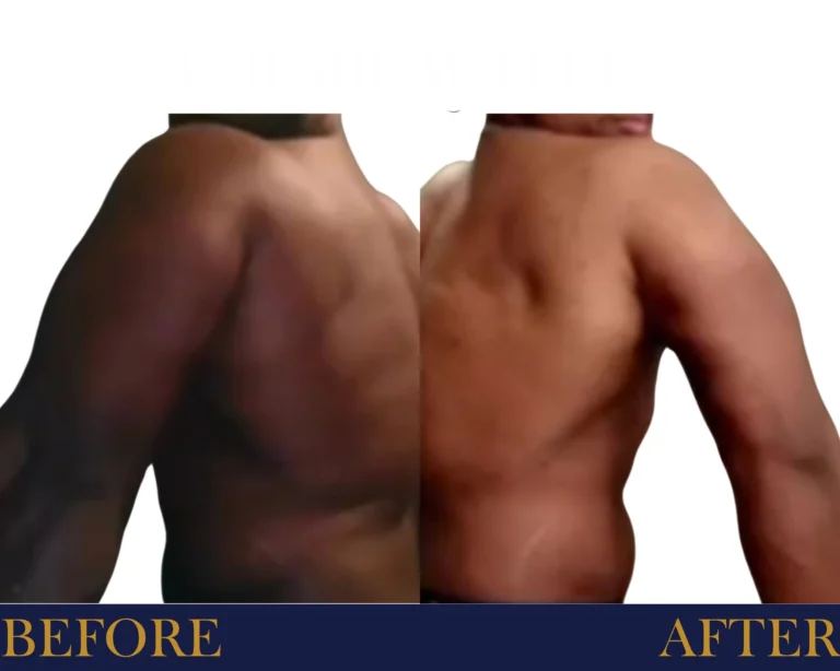 Weight Loss Program Before and After Result- Jules Aesthetics