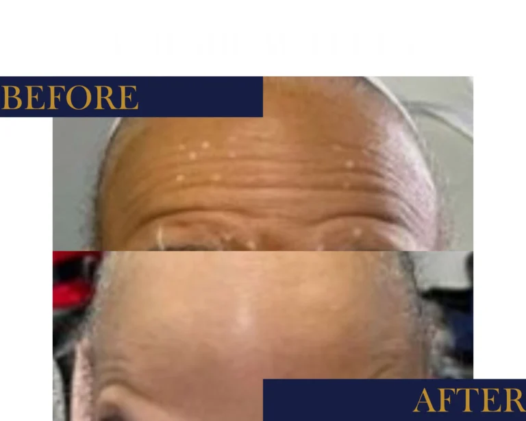 Neurotoxin Before and After Result- Jules Aesthetics