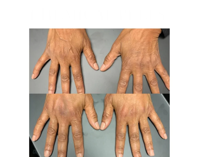 Biostimulator Fillers Before and After Result- Jules Aesthetics